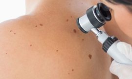 Skin Tag Removal: Cryotherapy Explained