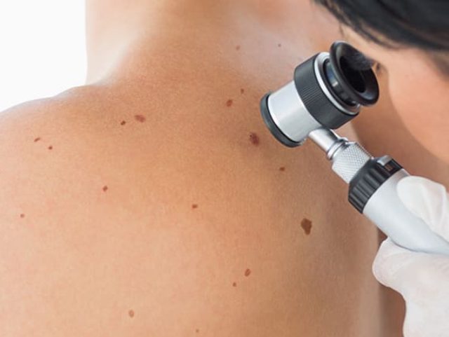 Read more about the article Skin Tag Removal: Cryotherapy Explained