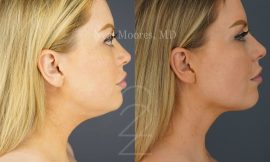 Neck Liposuction: Achieve a Youthful Appearance with Liposuction in Salt Lake City