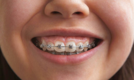 Teeth Braces and Your Diet: Foods to Avoid During Treatment