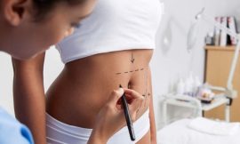 The Recovery Process After a Tummy Tuck in Dubai