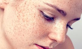 Pigmentation Disorder Treatment Market: Comprehensive Insights 2032