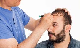 How to speed up hair transplant recovery?