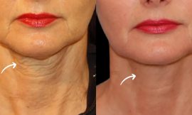 How Sculptra in Dubai Works: Everything You Need to Know