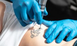 Laser Tattoo Removal for Small, Medium, and Large Tattoos in Dubai