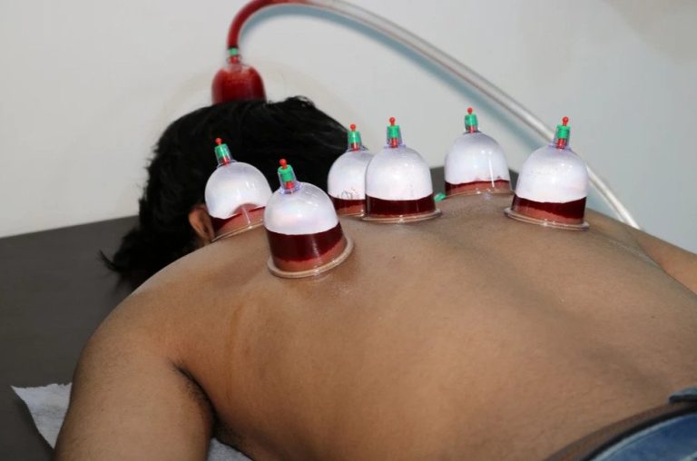 Read more about the article How Hijama Cupping Enhances Blood Flow