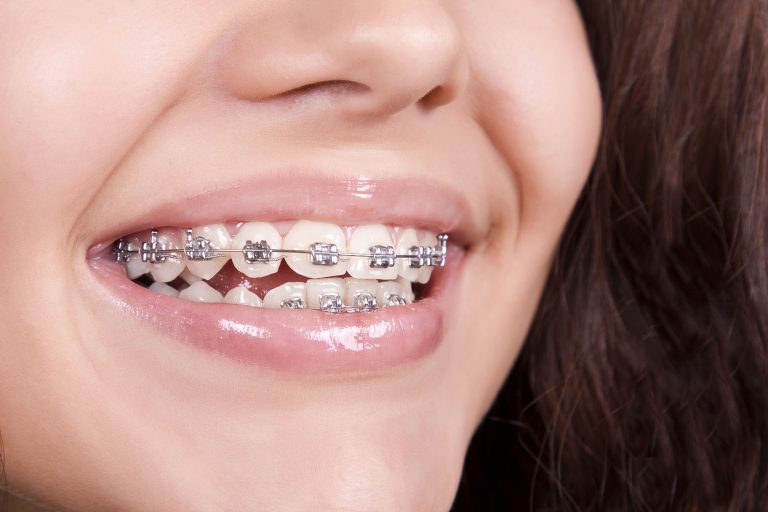 Read more about the article How much does orthodontic treatment with braces cost for people with crowded teeth in Dubai?