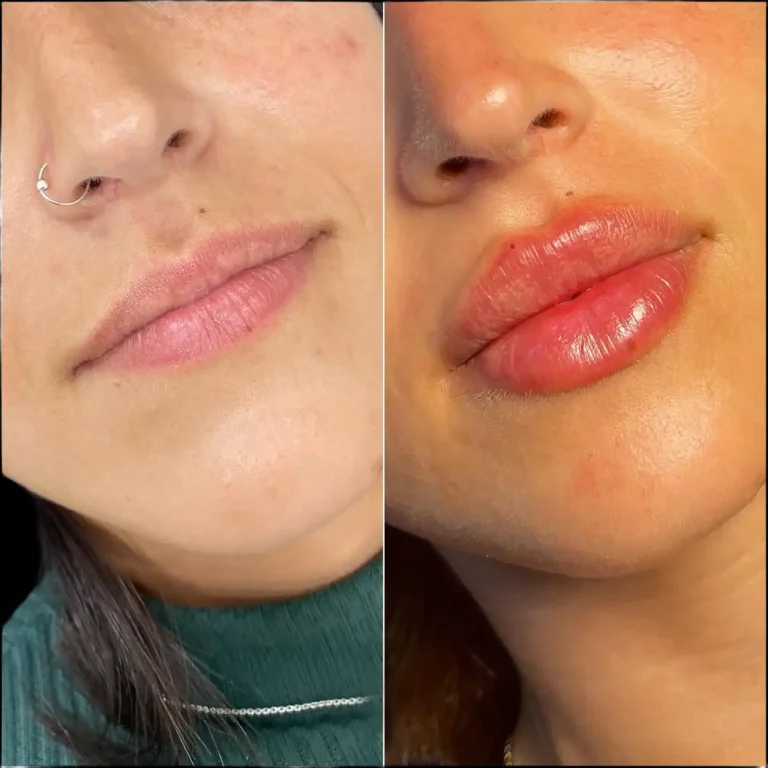 Read more about the article Juvederm treatment in dubai: How It Works and What to Expect