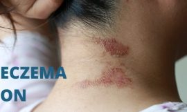 What Causes Dermatitis on the Back of the Neck? Symptoms and Solutions