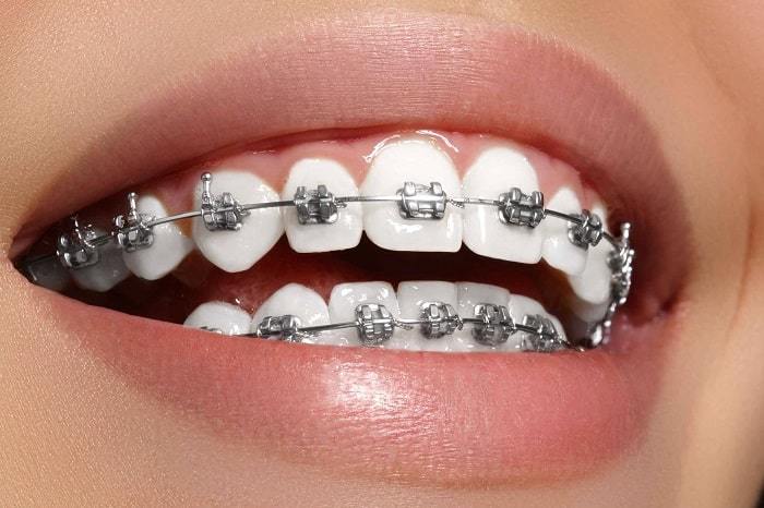 Read more about the article Dental Braces in Dubai: Unlocking the Health Benefits You Never Expected