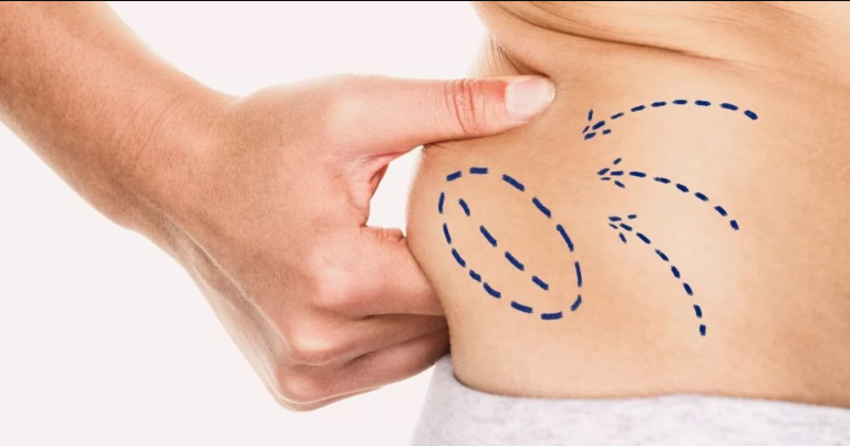 Read more about the article The Impact of Stomach Liposuction in Dubai on Your Daily Routine