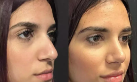 Cost, Process, and Recovery: Your Essential Guide to Rhinoplasty in Dubai