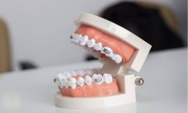 Exploring the Long-Term Benefits of Braces in Dubai