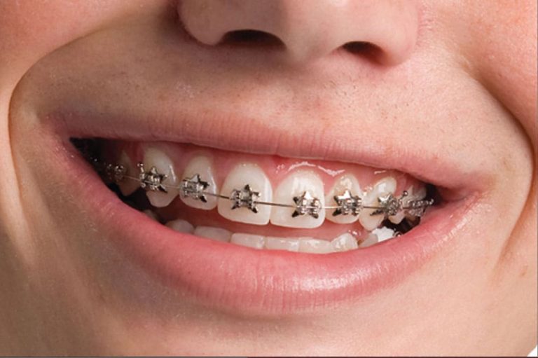 Read more about the article Getting Your Teeth Braces in Dubai: A Step-by-Step Guide