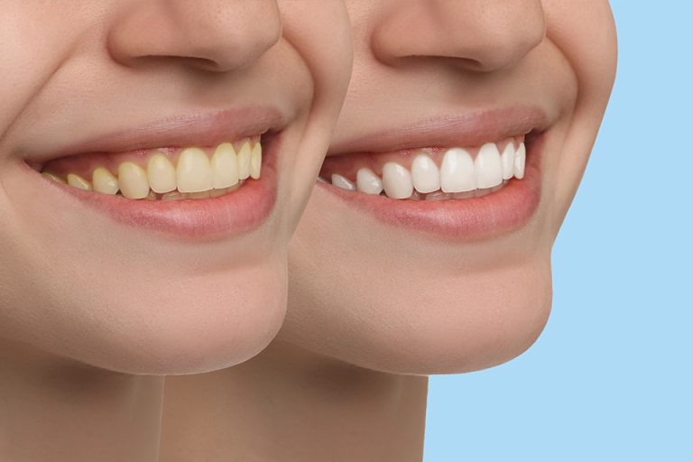 Read more about the article Feel Confident with a Brighter Smile Teeth Whitening in Dubai