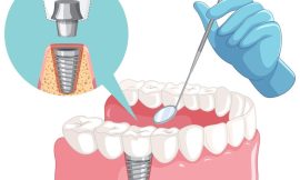 Dental Health Resolutions: Prioritizing Dental Checkups and Implants