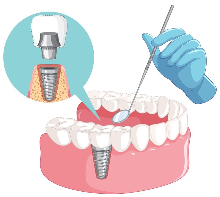 dental implants