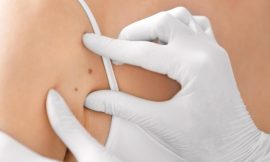 What Are the Most Common Reasons for Skin Tag Removal?