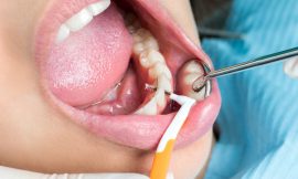 Your Guide to Dental Stain Removal in Dubai