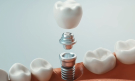 Dubai’s Premier Dental Implant Solutions for Everyone