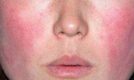 What Should You Discuss with Your Doctor About Rosacea Treatment?