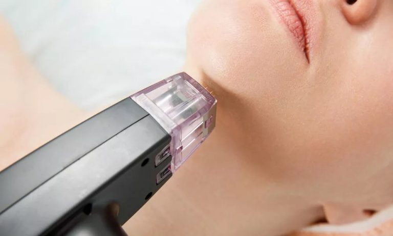 Read more about the article What Is the Best Age to Start Fractional RF Microneedling Treatments?