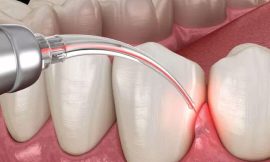 How a Gingivectomy in Dubai Can Help Treat Gum Disease