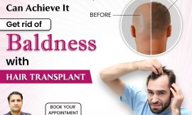 Ultimate Guide for Hair Transplant