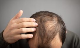 The Evolution of Hair Transplant Techniques