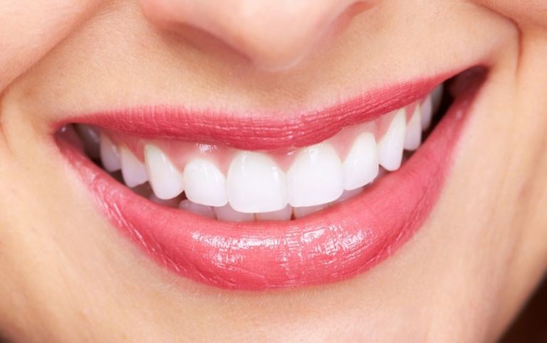 Read more about the article Why Choose Teeth Whitening in Silicon Oasis?