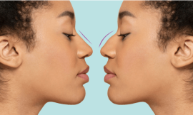 How Rhinoplasty Can Help Correct a Broken Nose or Trauma Related Deformities