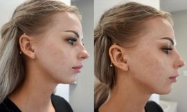 Before and After: Jawline Filler and Cheek Filler Transformations