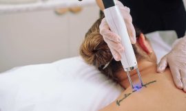 Affordable Laser Tattoo Removal in Dubai: Your Ultimate Guide to Savings