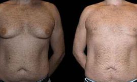 Complete Guide to Gynecomastia Cost in Dubai