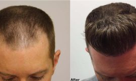 Male Hair Transplant in Dubai A Step-by-Step Guide to the Procedure