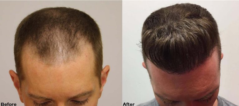 Read more about the article Male Hair Transplant in Dubai A Step-by-Step Guide to the Procedure