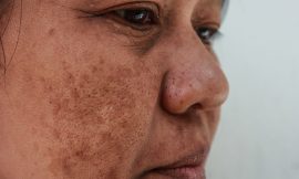 The Science Behind Melasma and Its Treatment in Dubai