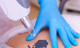 Picosure Tattoo Removal in Dubai: What Results Can You Expect?