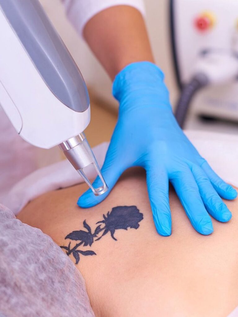 Read more about the article Picosure Tattoo Removal in Dubai: What Results Can You Expect?