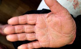 Plantar Hyperkeratosis: Causes, Symptoms, and Treatment Options