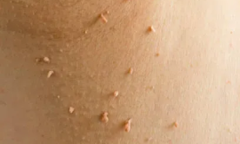 The Benefits of Professional Skin Tag Removal in Dubai