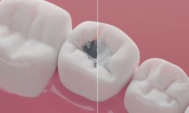 Get a Cleaner, Healthier Smile with SMART Amalgam Removal in Dubai