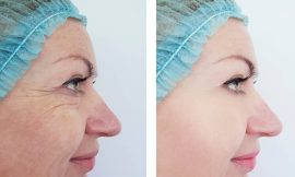 How to Choose the Best Clinic for Tear Trough Filler Treatment