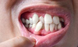 Find the Best Overlapping Teeth Treatment Options in Dubai