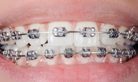 How to Afford Braces for Multiple Family Members in Dubai