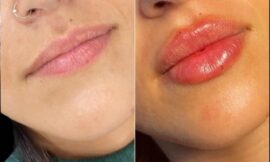 Best Doctors in Dubai for Lip Fillers: Top Picks