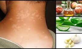 Tinea Versicolor Cures: Natural Ways to Restore Your Skin’s Health