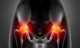 Hip Replacement Surgery in India: A Comprehensive Guide