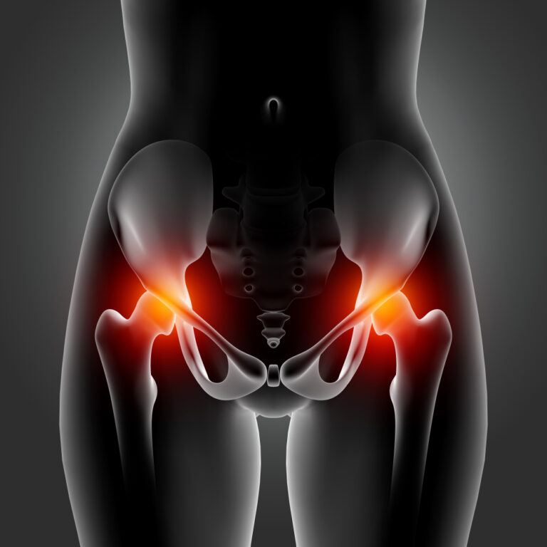 Read more about the article Hip Replacement Surgery in India: A Comprehensive Guide