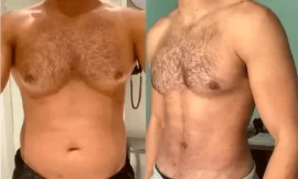 Gynecomastia in Dubai: Why Early Treatment Matter